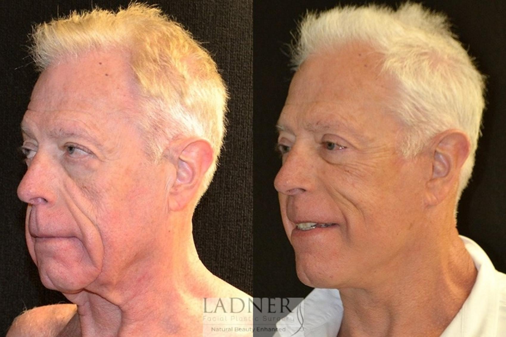 Facial Plastic Surgery for Men Case 30 Before & After Left Oblique | Denver, CO | Ladner Facial Plastic Surgery