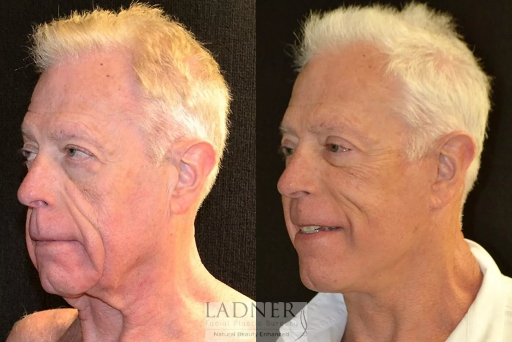 Facelift & Neck Lift in Denver, CO  Ladner Facial Plastic Surgery: Keith  Ladner, MD