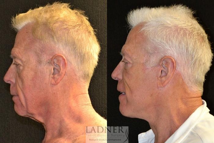 Facial Plastic Surgery for Men Case 30 Before & After Left Side | Denver, CO | Ladner Facial Plastic Surgery