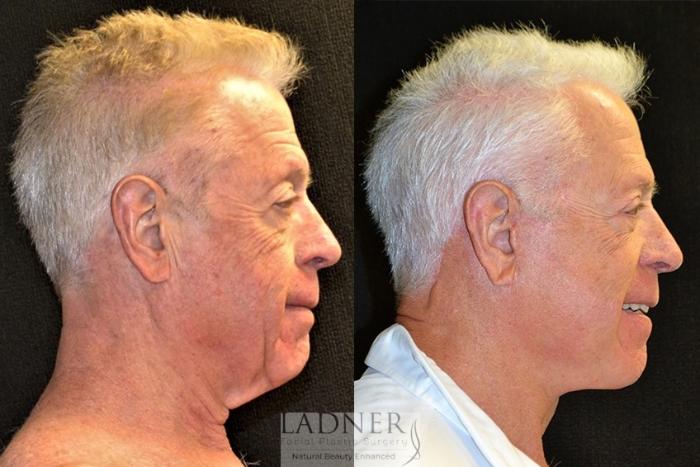 Facial Plastic Surgery for Men Case 30 Before & After Right Side | Denver, CO | Ladner Facial Plastic Surgery