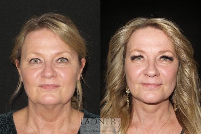 Facelift / Neck Lift Case 31 Before & After Front | Denver, CO | Ladner Facial Plastic Surgery