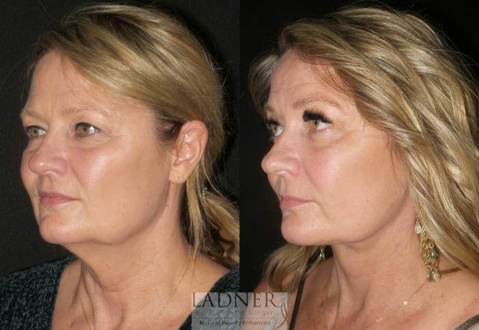 Facelift / Neck Lift Case 31 Before & After Left Oblique | Denver, CO | Ladner Facial Plastic Surgery