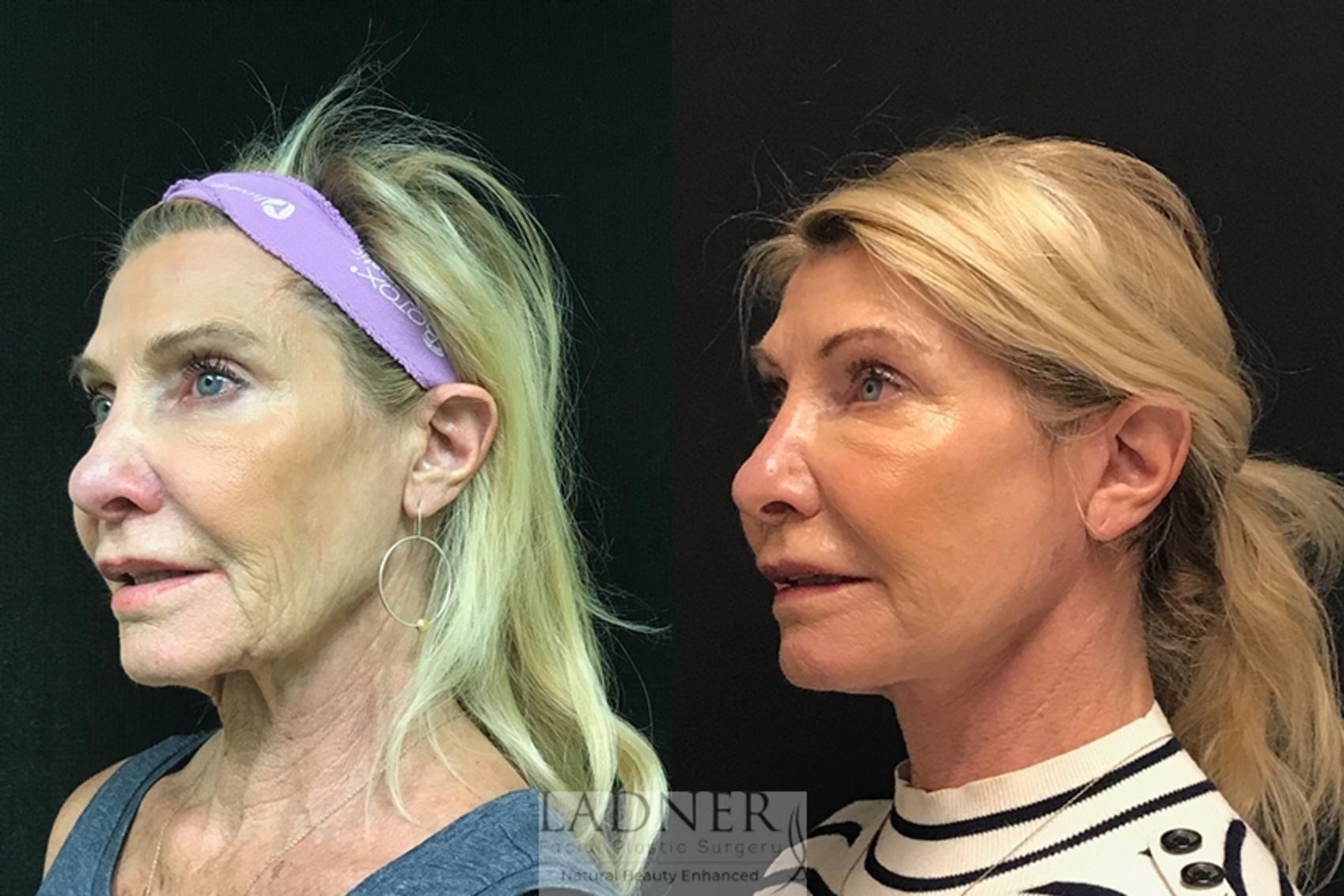 Facelift Neck Lift Before And After Pictures Case Denver CO Ladner Facial Plastic Surgery