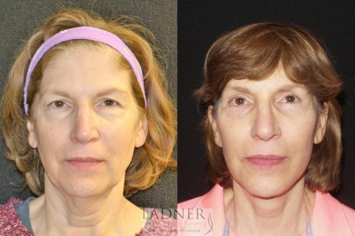 Brow Lift / Forehead Lift Case 33 Before & After Front | Denver, CO | Ladner Facial Plastic Surgery