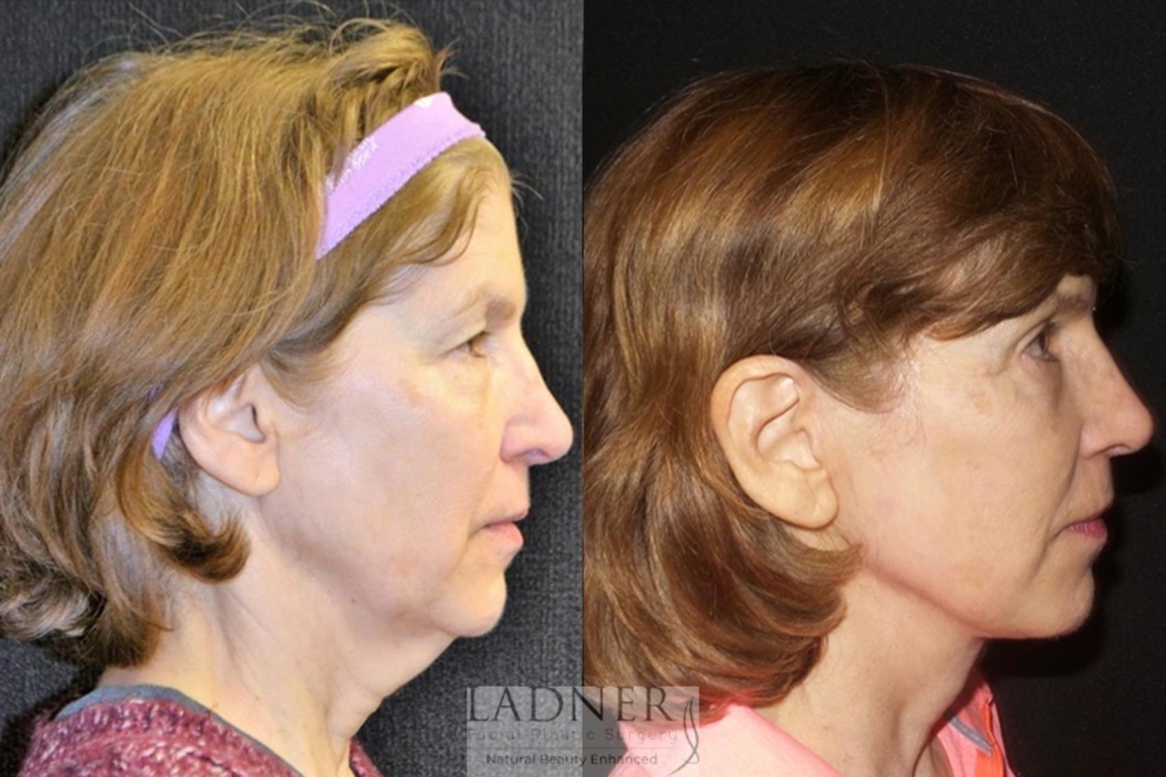 Facial Rejuvenation Case 33 Before & After Right Side | Denver, CO | Ladner Facial Plastic Surgery