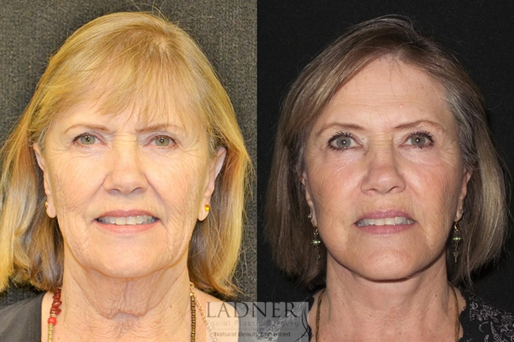 Facelift / Neck Lift Case 34 Before & After Front | Denver, CO | Ladner Facial Plastic Surgery