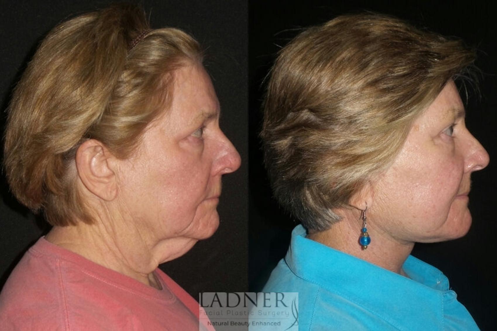 Facial Rejuvenation Case 35 Before & After Right Side | Denver, CO | Ladner Facial Plastic Surgery