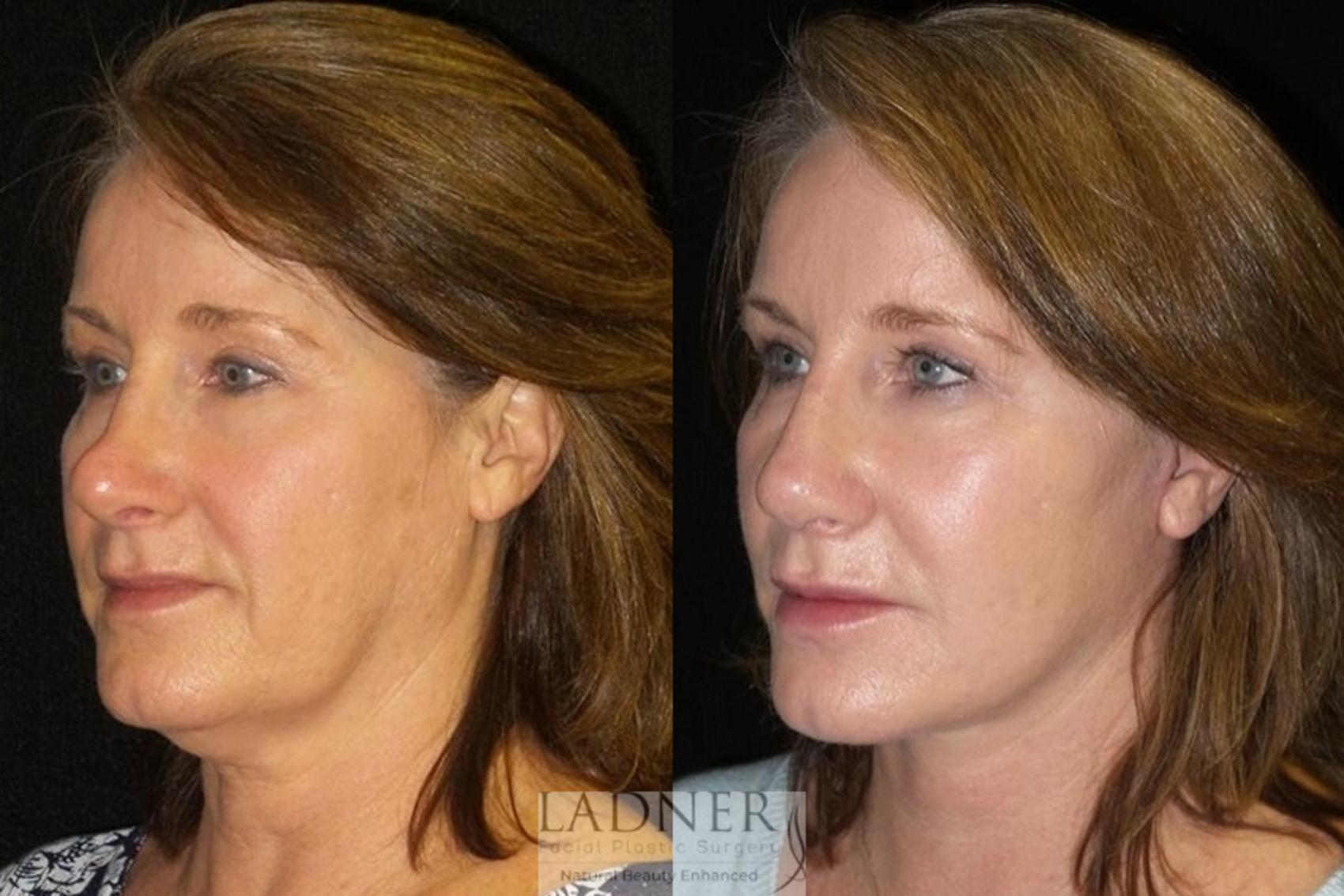 Facelift / Neck Lift Case 36 Before & After Left Oblique | Denver, CO | Ladner Facial Plastic Surgery