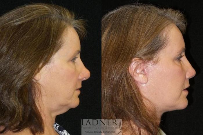 Facelift / Neck Lift Case 36 Before & After Right Side | Denver, CO | Ladner Facial Plastic Surgery