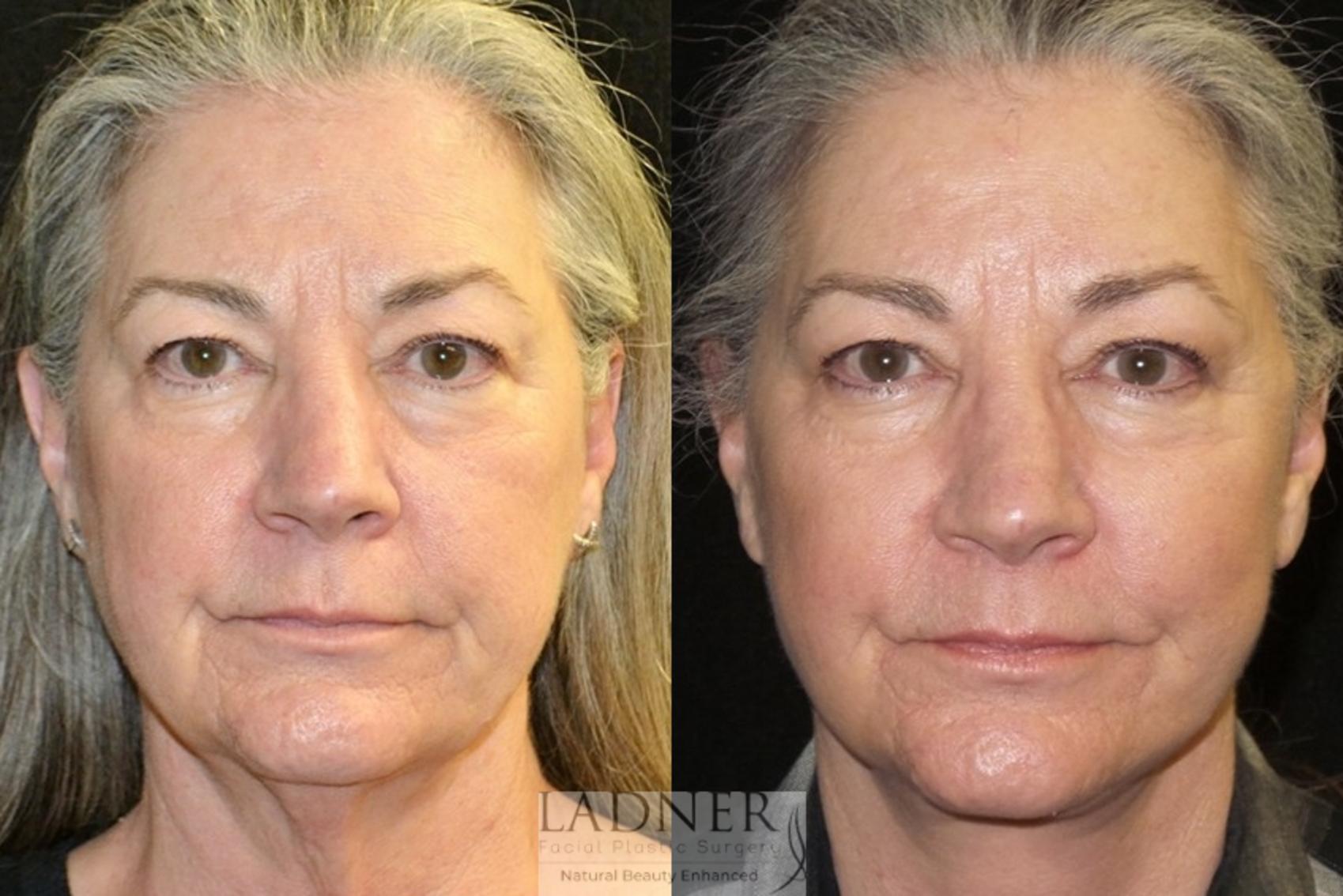 Facelift / Neck Lift Case 39 Before & After Front | Denver, CO | Ladner Facial Plastic Surgery