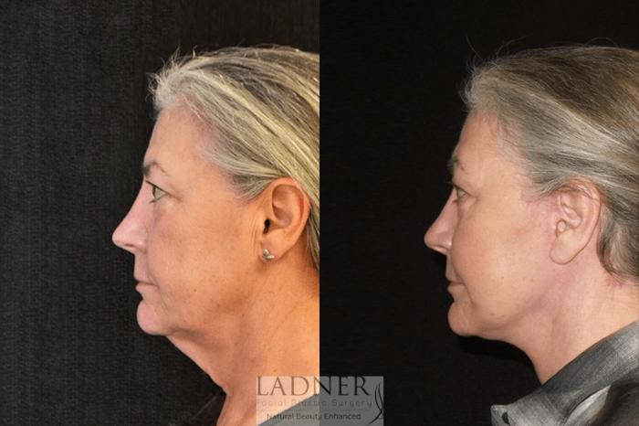 Facelift / Neck Lift Case 39 Before & After Left Side | Denver, CO | Ladner Facial Plastic Surgery