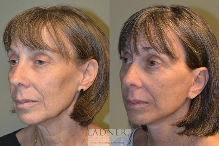 Facelift / Neck Lift Case 40 Before & After Left Oblique | Denver, CO | Ladner Facial Plastic Surgery