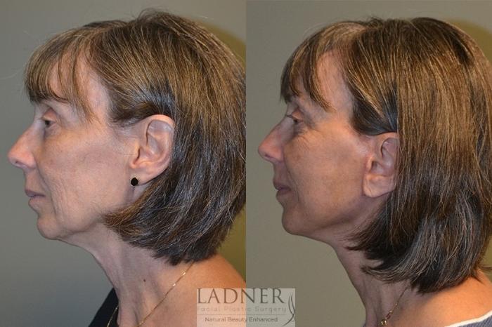 Facelift / Neck Lift Case 40 Before & After Left Side | Denver, CO | Ladner Facial Plastic Surgery