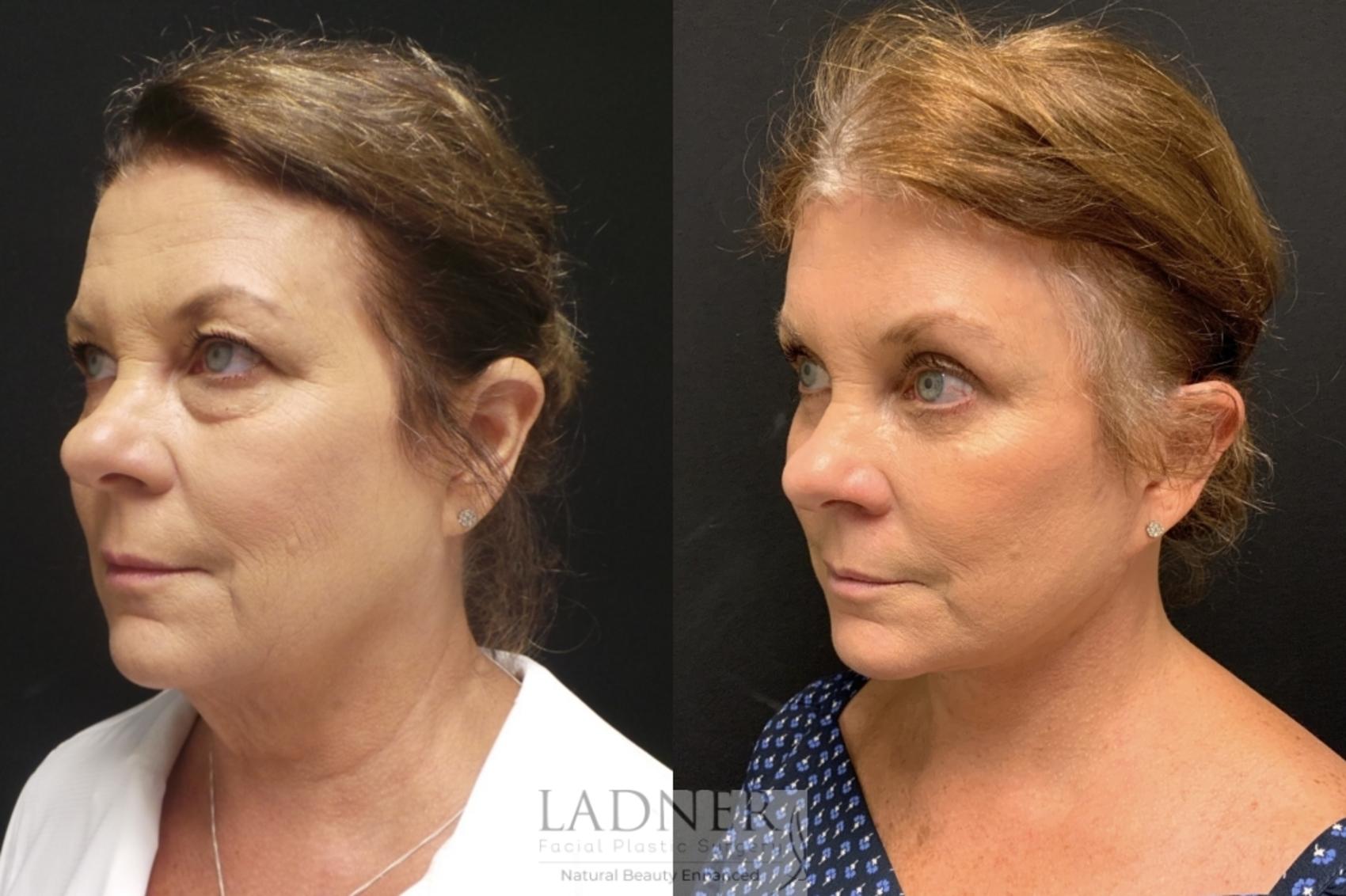 Facelift / Neck Lift Case 93 Before & After Left 3/4 View | Denver, CO | Ladner Facial Plastic Surgery