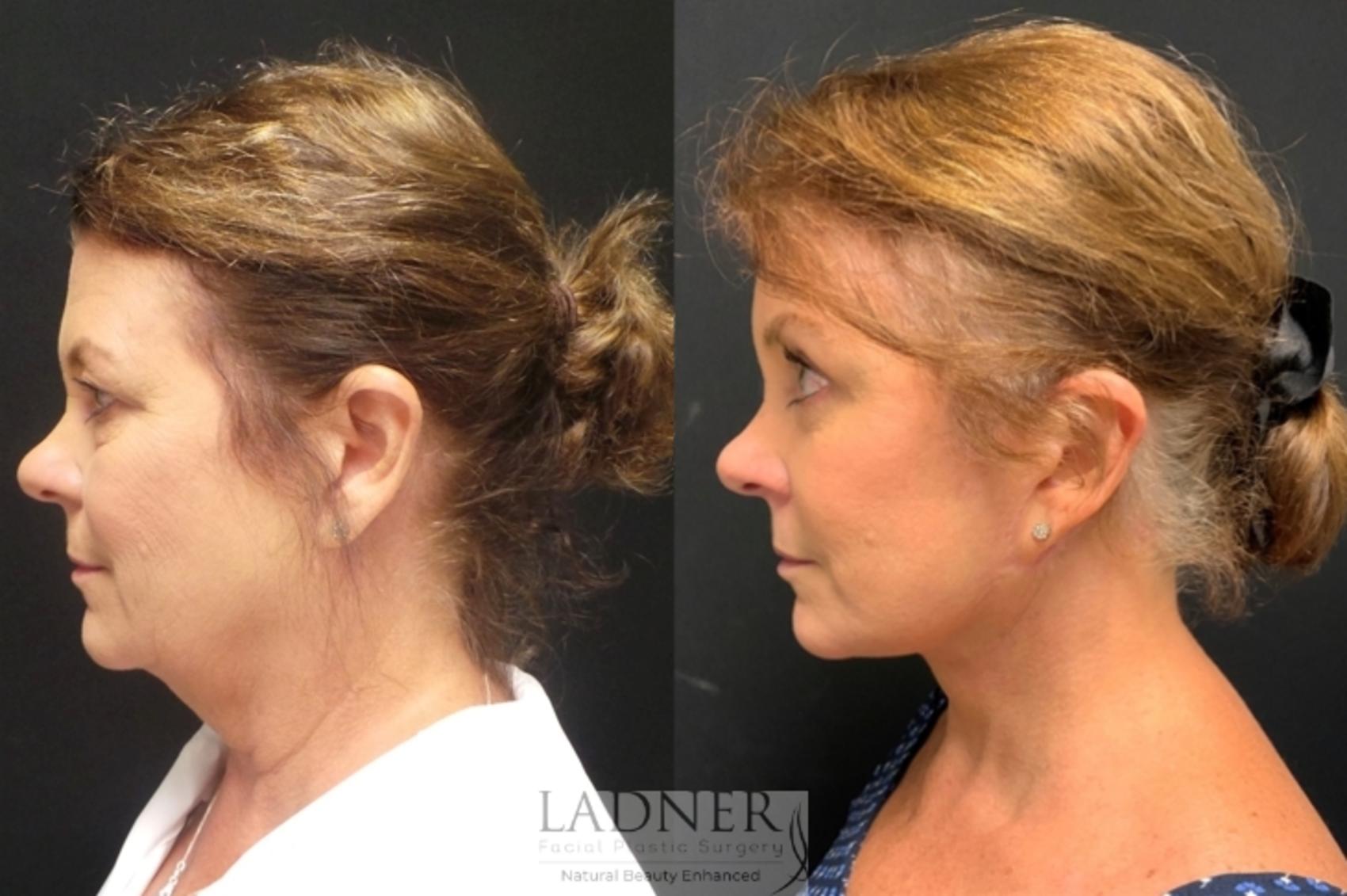 Facial Fat Transfer / Liposuction Case 93 Before & After Left Side | Denver, CO | Ladner Facial Plastic Surgery
