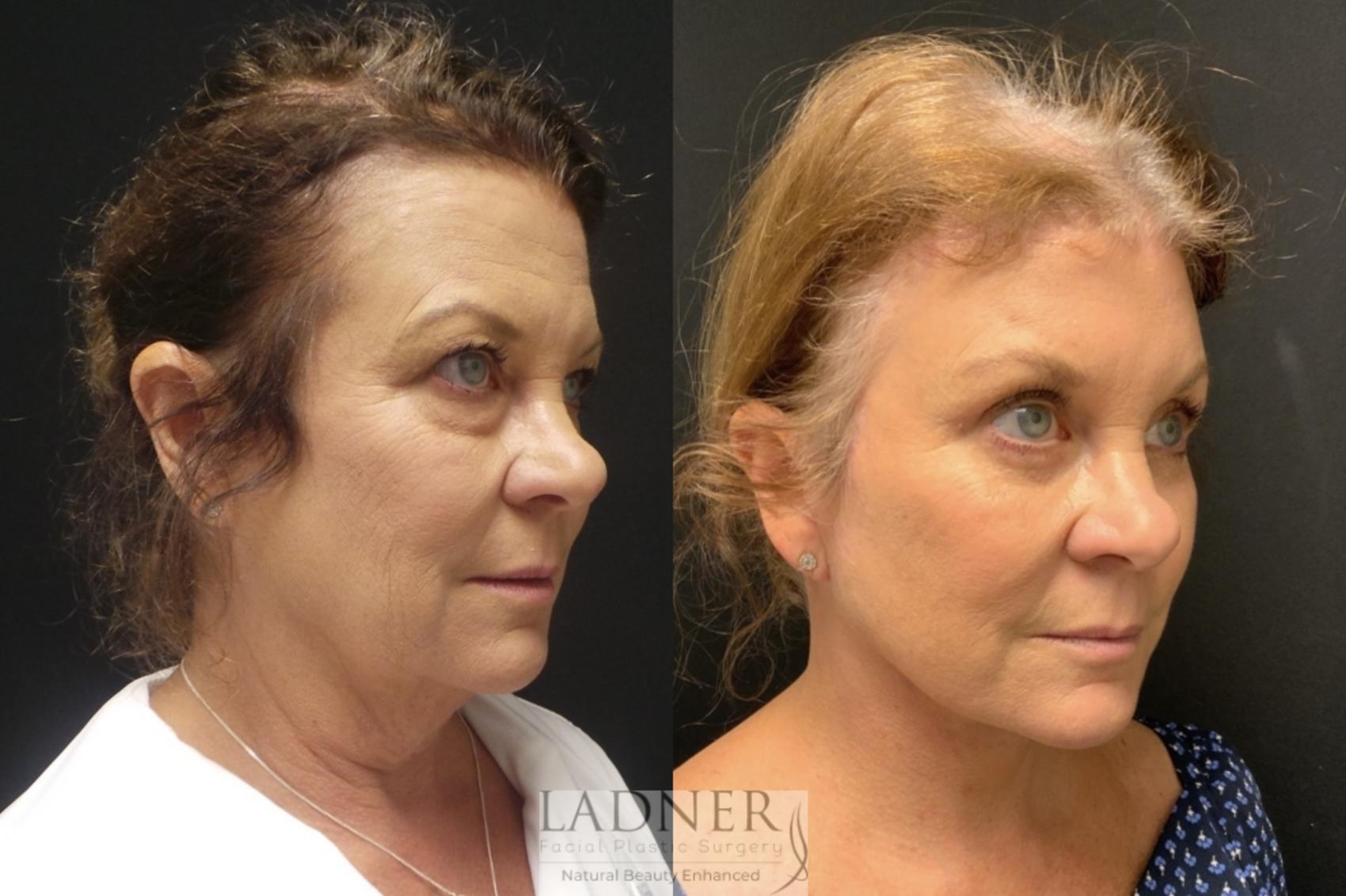 Facelift / Neck Lift Case 93 Before & After Right 3/4 View | Denver, CO | Ladner Facial Plastic Surgery
