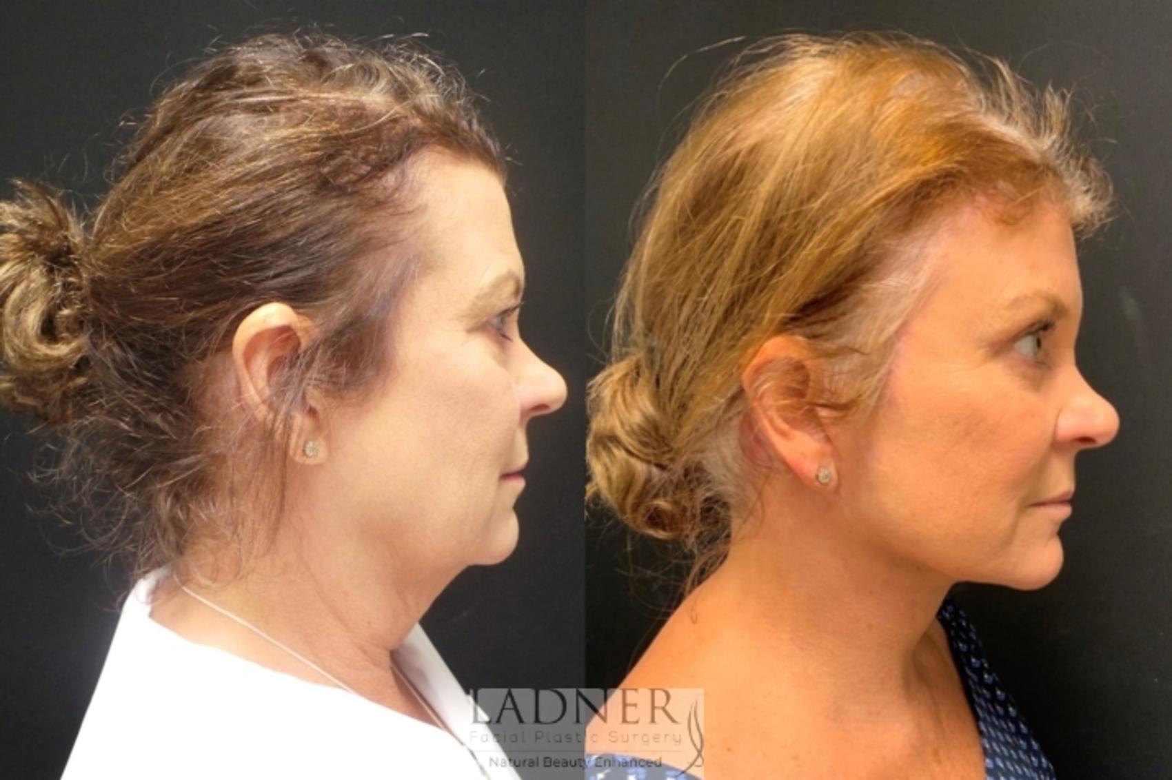 Facelift / Neck Lift Case 93 Before & After Right Side | Denver, CO | Ladner Facial Plastic Surgery