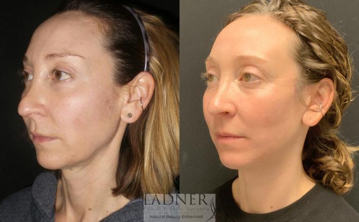 Facelift / Neck Lift Case 94 Before & After Left Oblique | Denver, CO | Ladner Facial Plastic Surgery