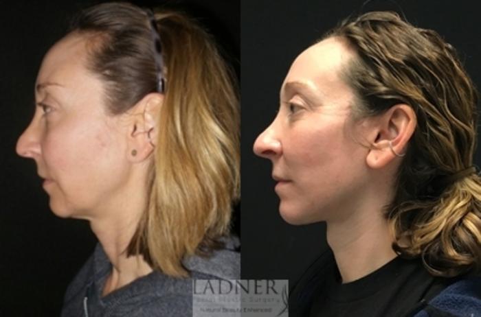 Facelift / Neck Lift Case 94 Before & After Left Side | Denver, CO | Ladner Facial Plastic Surgery