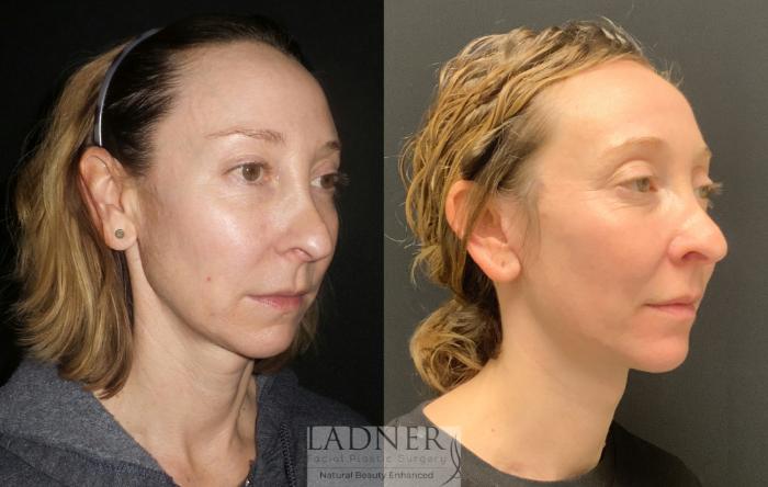 Facelift / Neck Lift Case 94 Before & After Right Oblique | Denver, CO | Ladner Facial Plastic Surgery