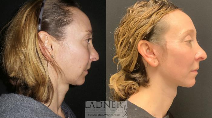 Facelift / Neck Lift Case 94 Before & After Right Side | Denver, CO | Ladner Facial Plastic Surgery