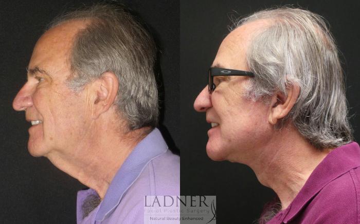 Facelift / Neck Lift Case 96 Before & After Left Side | Denver, CO | Ladner Facial Plastic Surgery