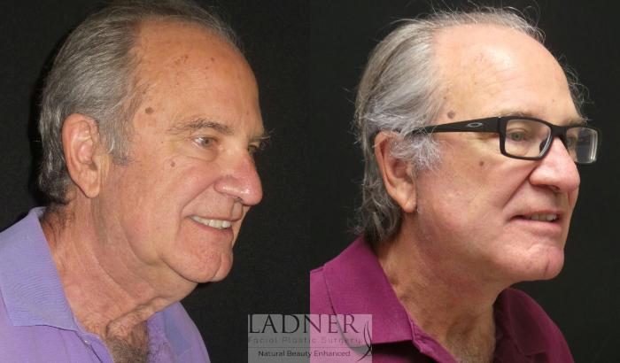 Facelift / Neck Lift Case 96 Before & After Right Oblique | Denver, CO | Ladner Facial Plastic Surgery