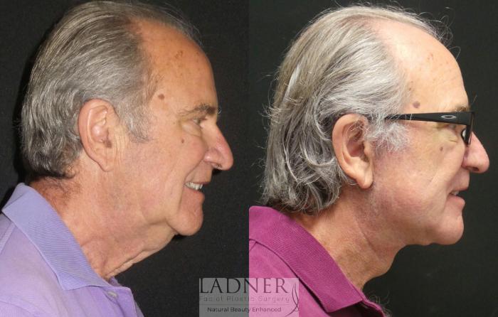 Facelift / Neck Lift Case 96 Before & After Right Side | Denver, CO | Ladner Facial Plastic Surgery