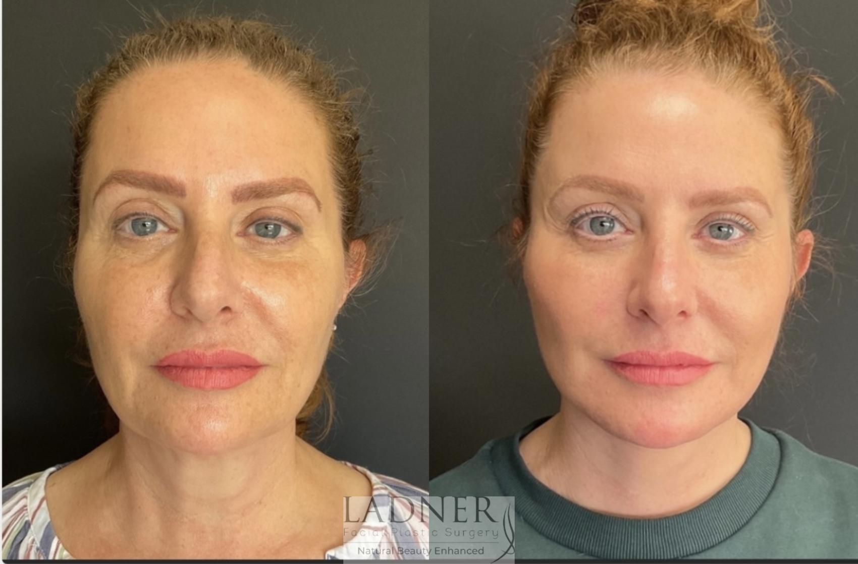 Facial Fat Transfer Case 154 Before & After Front | Denver, CO | Ladner Facial Plastic Surgery