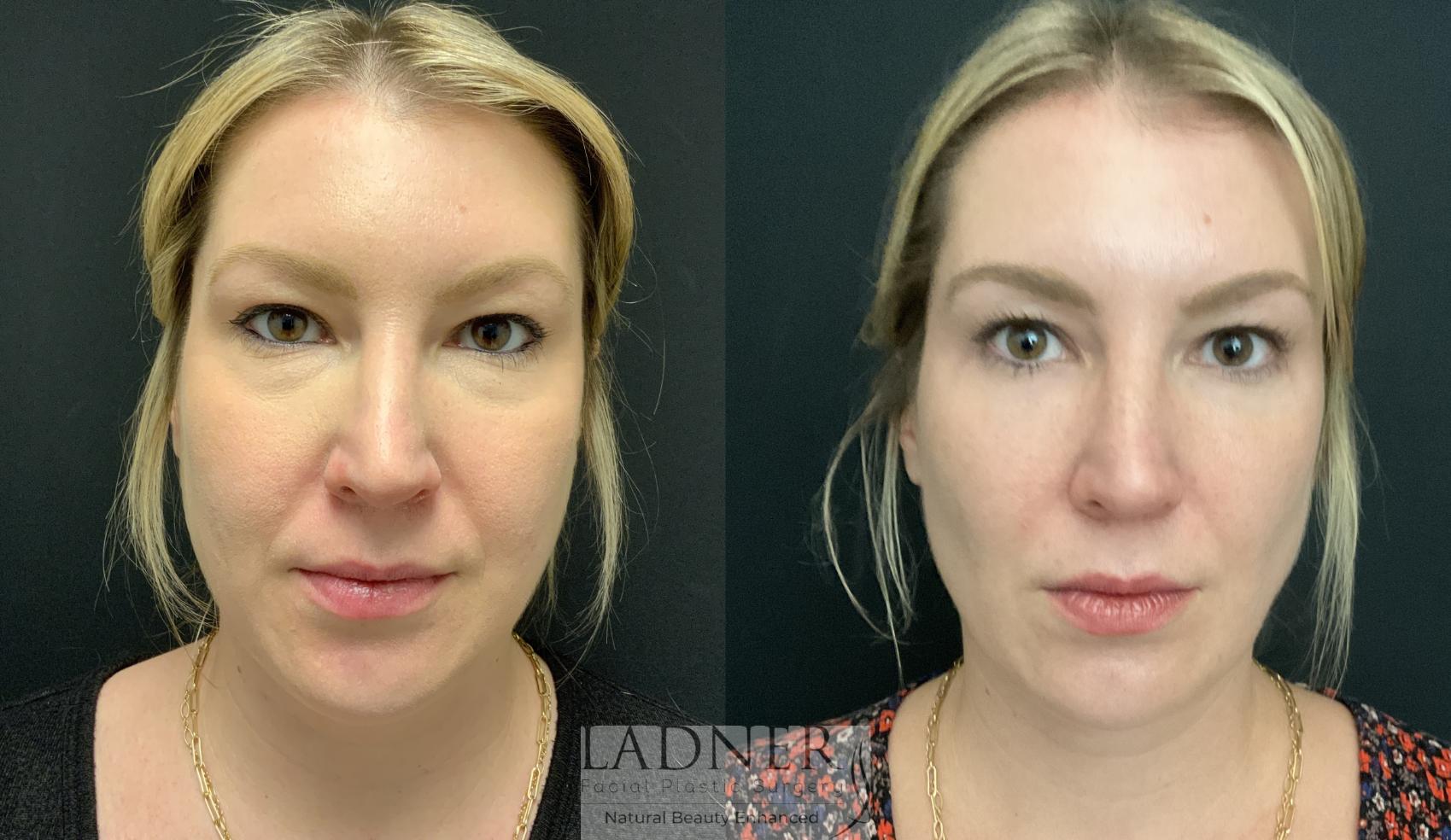 Buccal Fat Removal Case 158 Before & After Front | Denver, CO | Ladner Facial Plastic Surgery