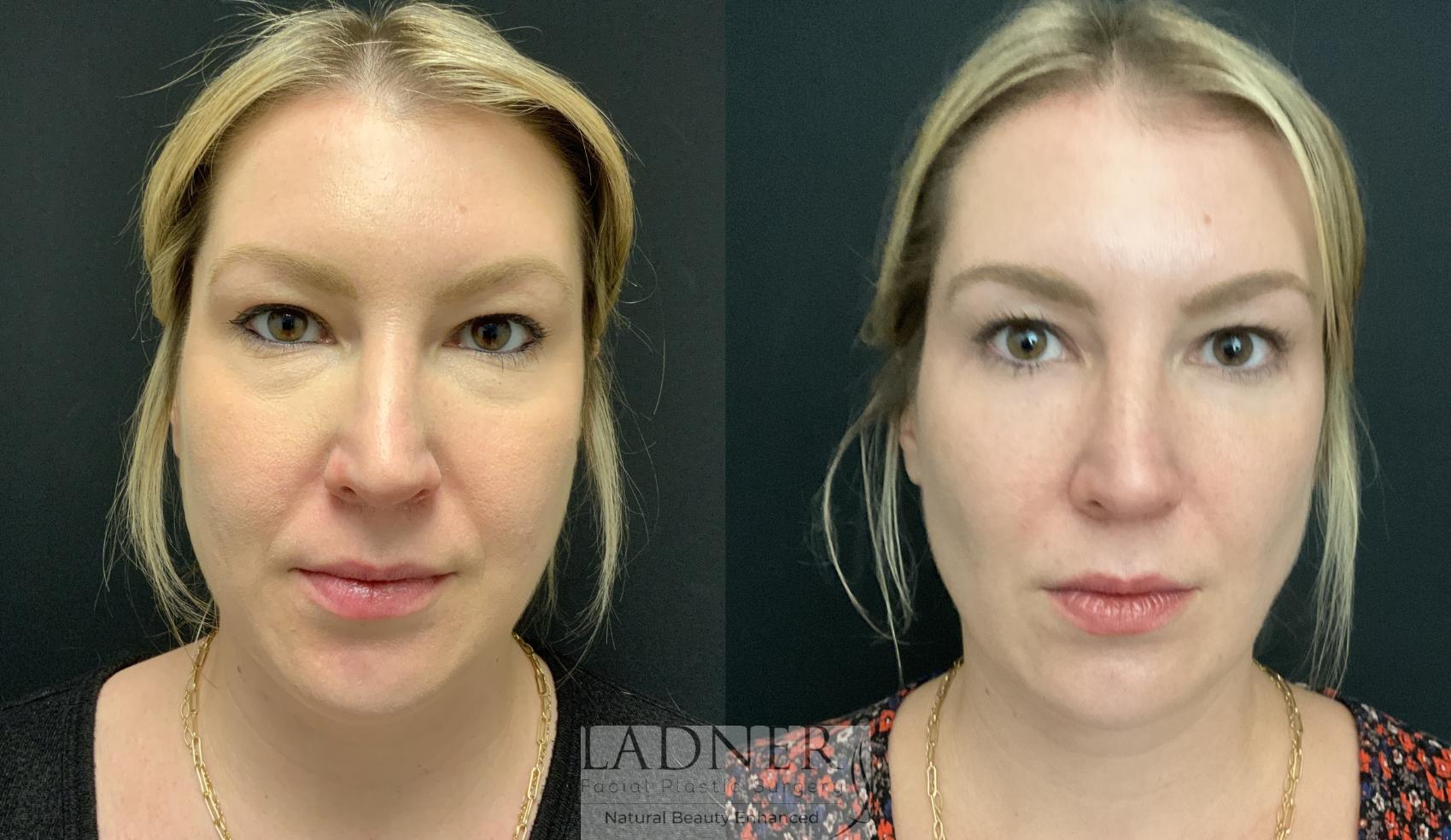 Plastic Surgery Fat Injections Face Sale Online Www simpleplanning