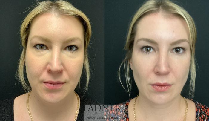 Facial Fat Transfer Case 158 Before & After Front | Denver, CO | Ladner Facial Plastic Surgery