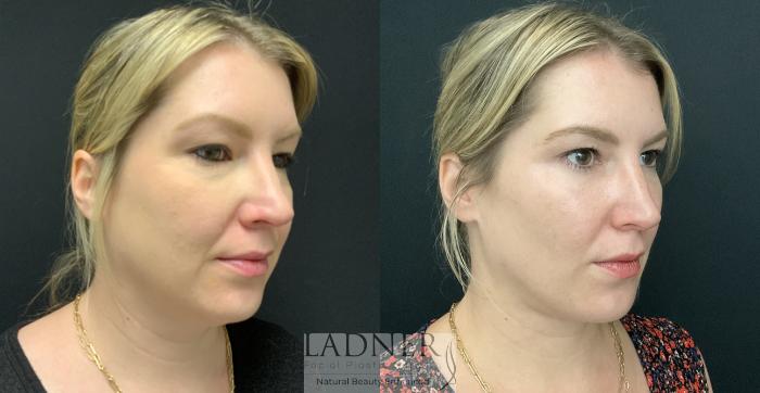 Buccal Fat Removal Case 158 Before & After Right Oblique | Denver, CO | Ladner Facial Plastic Surgery
