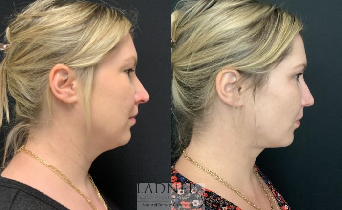 Facial Fat Transfer Case 158 Before & After Right Side | Denver, CO | Ladner Facial Plastic Surgery