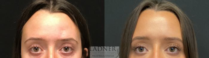 Facial Fat Transfer Case 159 Before & After Front | Denver, CO | Ladner Facial Plastic Surgery