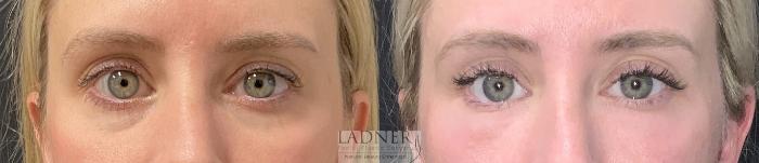 Facial Fat Transfer Case 237 Before & After Front | Denver, CO | Ladner Facial Plastic Surgery