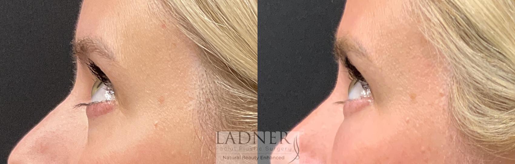 Facial Fat Transfer Case 237 Before & After Left Side | Denver, CO | Ladner Facial Plastic Surgery