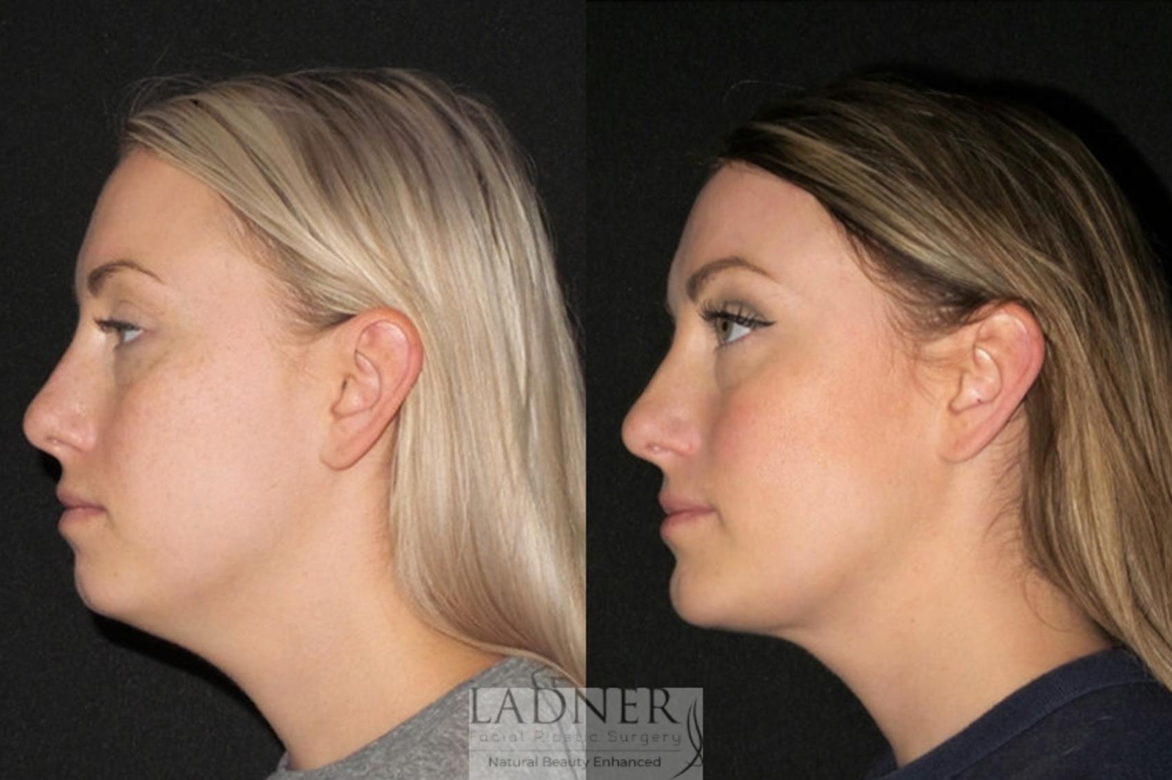Chin Augmentation / Buccal Fat Removal Case 68 Before & After Left Side | Denver, CO | Ladner Facial Plastic Surgery