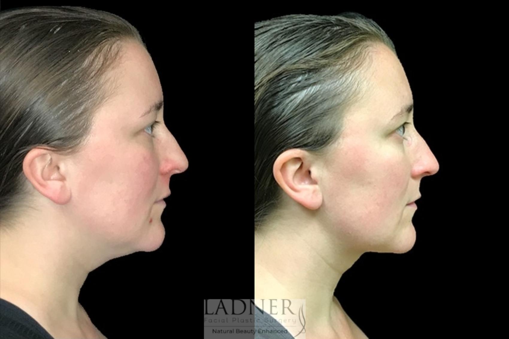 Facial Fat Transfer / Liposuction Case 72 Before & After Right Side | Denver, CO | Ladner Facial Plastic Surgery