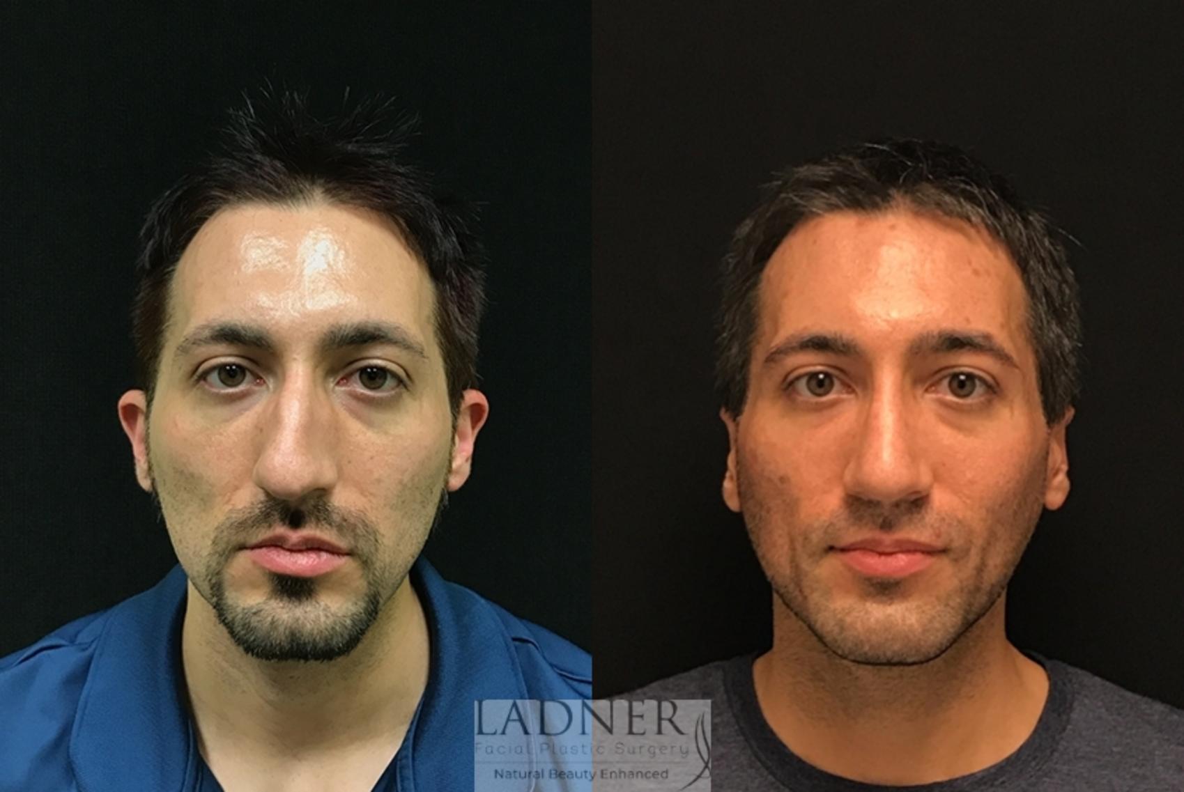 Chin Augmentation / Buccal Fat Removal Case 18 Before & After Front | Denver, CO | Ladner Facial Plastic Surgery