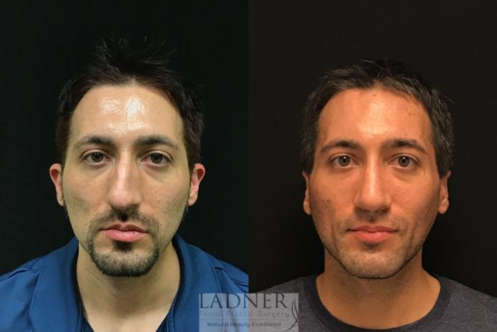 Facial Plastic Surgery for Men Case 18 Before & After Front | Denver, CO | Ladner Facial Plastic Surgery