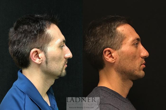 Facial Plastic Surgery for Men Case 18 Before & After Right Side | Denver, CO | Ladner Facial Plastic Surgery
