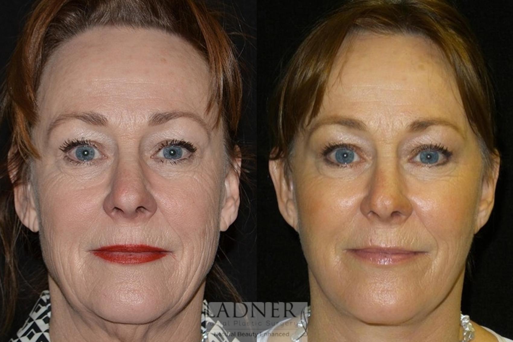 Laser Skin Resurfacing Case 37 Before & After Front | Denver, CO | Ladner Facial Plastic Surgery
