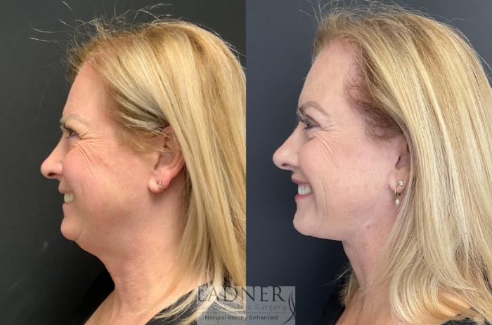 Lip Lift Case 123 Before & After Left Side | Denver, CO | Ladner Facial Plastic Surgery