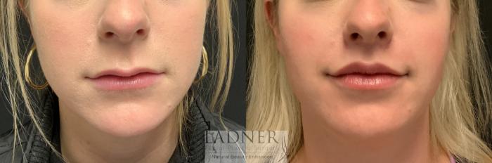 Lip Lift Case 220 Before & After Front | Denver, CO | Ladner Facial Plastic Surgery