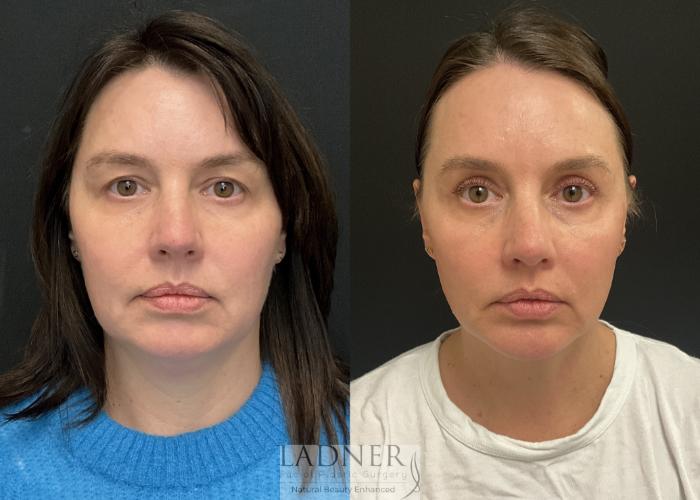 Minimally Invasive Neck Tightening Case 228 Before & After Front | Denver, CO | Ladner Facial Plastic Surgery