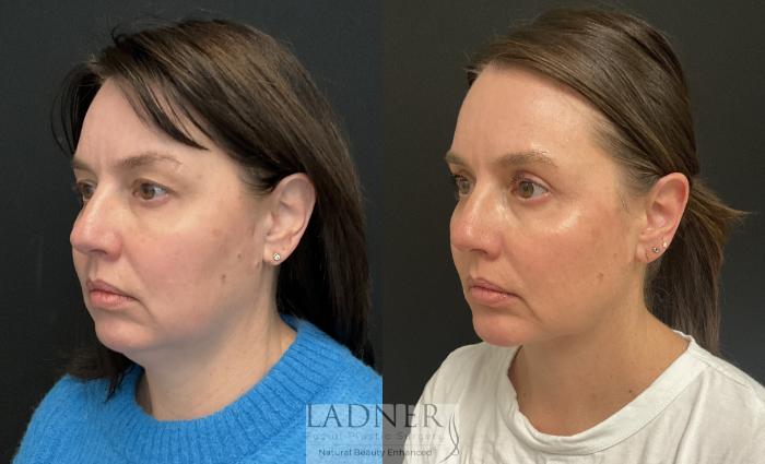 Submental Liposuction Case 228 Before & After Left Oblique | Denver, CO | Ladner Facial Plastic Surgery