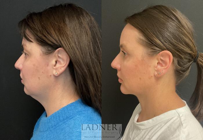 Submental Liposuction Case 228 Before & After Left Side | Denver, CO | Ladner Facial Plastic Surgery
