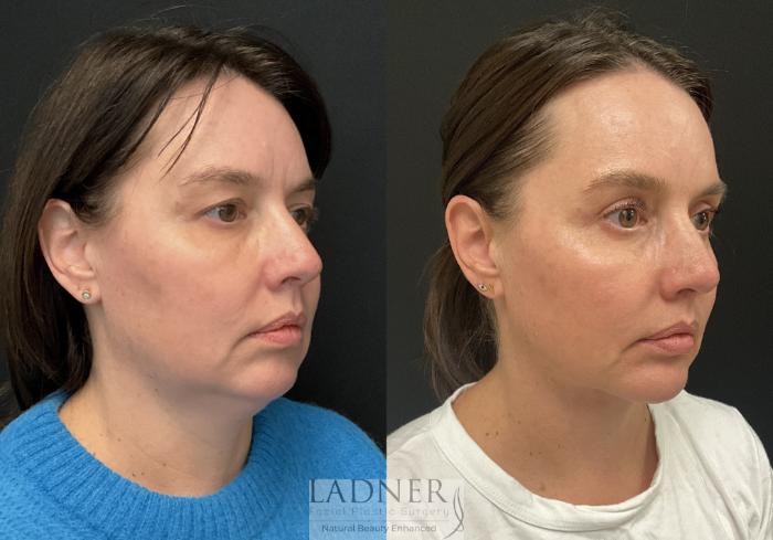 Chin Augmentation Case 228 Before & After Right Oblique | Denver, CO | Ladner Facial Plastic Surgery