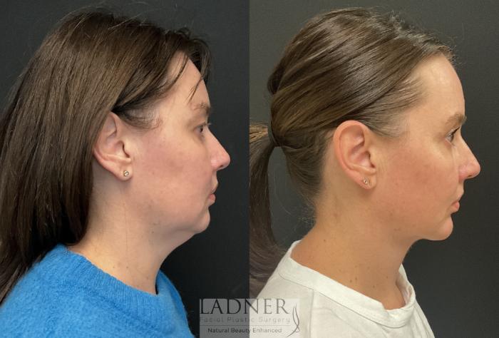 Chin Augmentation Case 228 Before & After Right Side | Denver, CO | Ladner Facial Plastic Surgery